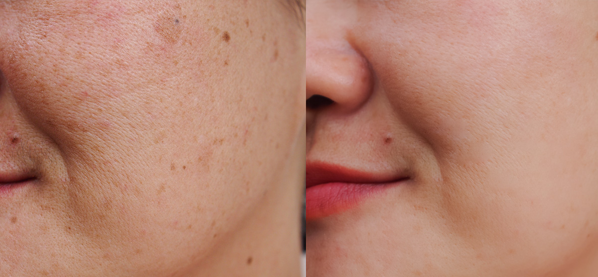 Acne in Henderson and Las Vegas.