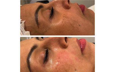 Dermaplaning in Henderson, NV.